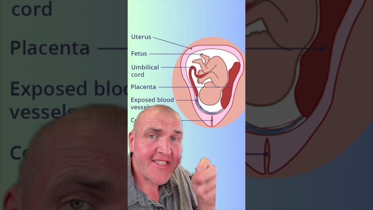 Niesprawne linie ratunkowe: Vasa Previa #nauka #medycyna #anatomia