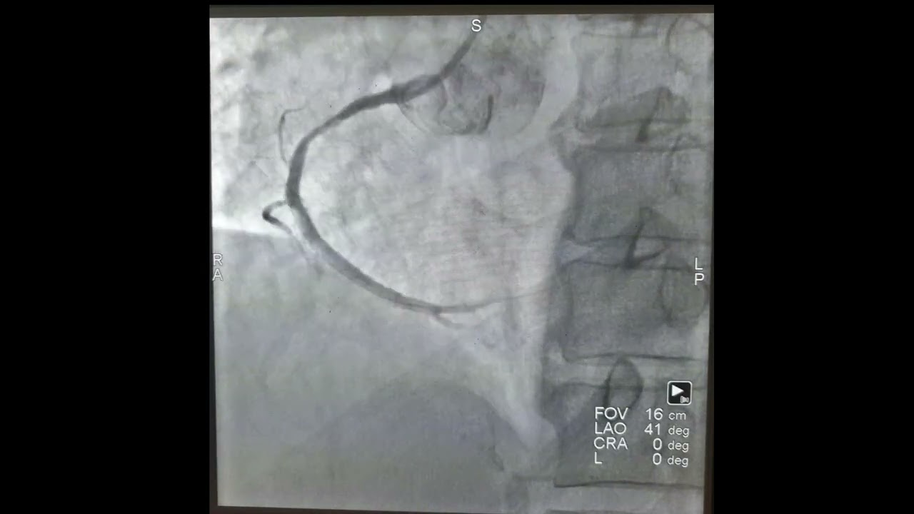 Tindakan PCI 2 stent/ring di arteri koroner kanan/ RCA🫀🫀 #cathlab #cardiac