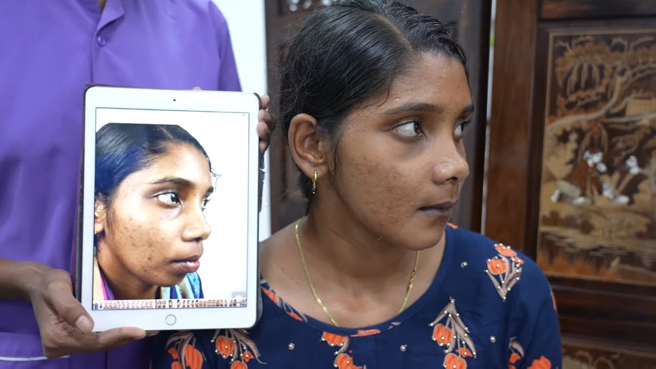 Orthognathic Upper and lower jaw Surgery result - Dr. Sunil Richardson