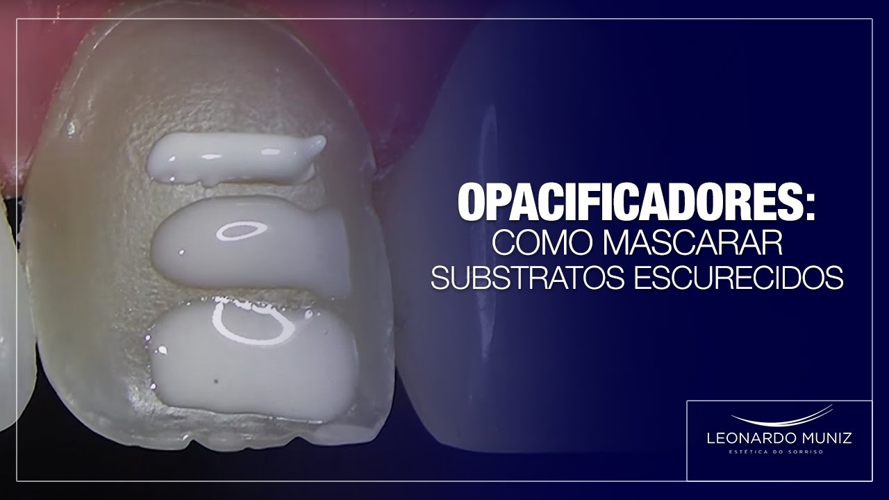Opacificadores: Como mascarar substratos escurecidos | Leonardo Muniz