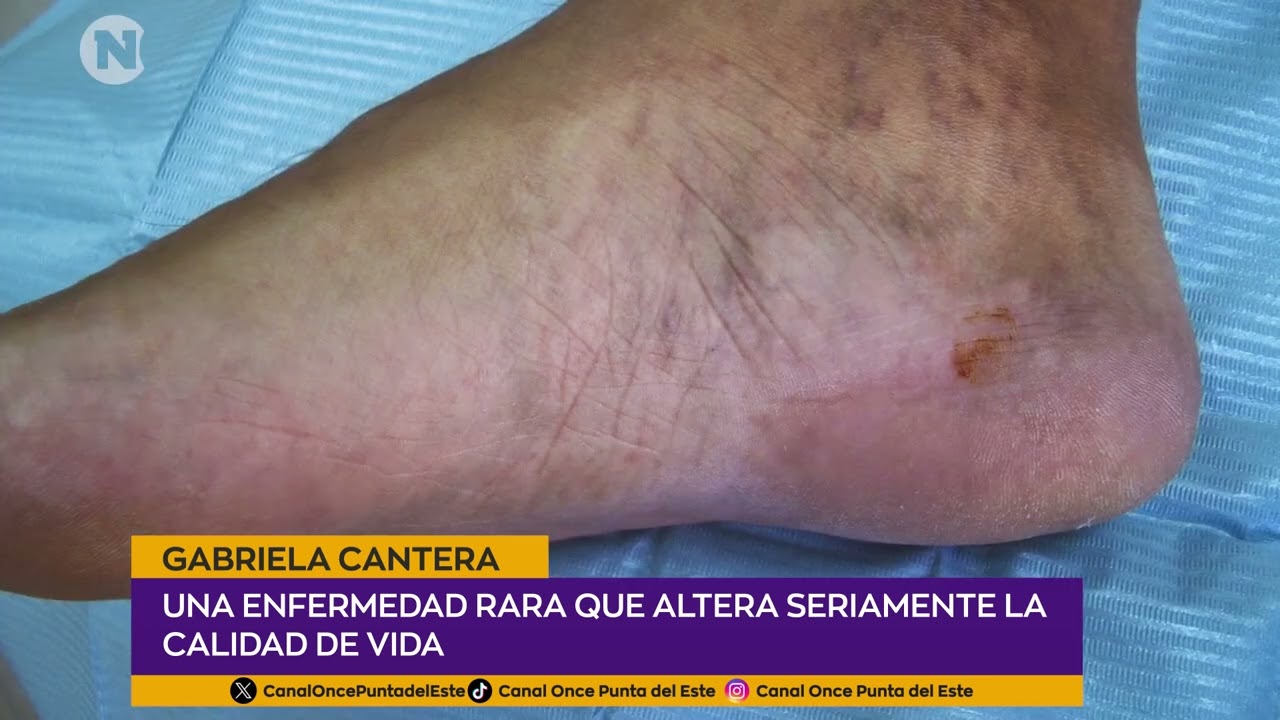 SUDECK | Gabriela Cantera - Paciente con sindrome de Sudeck.