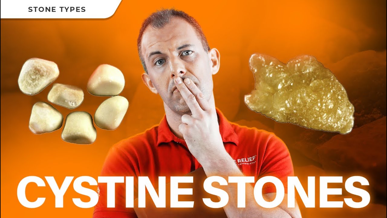 Cystine Kidney Stones Explained: Causes, Prevention, and Best Treatments for Cystinuria