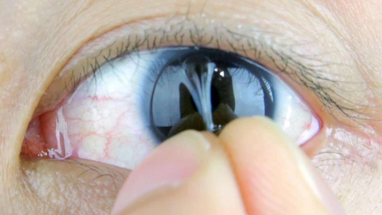How to Easily Remove Contacts V2 | BeatTheBush DIY