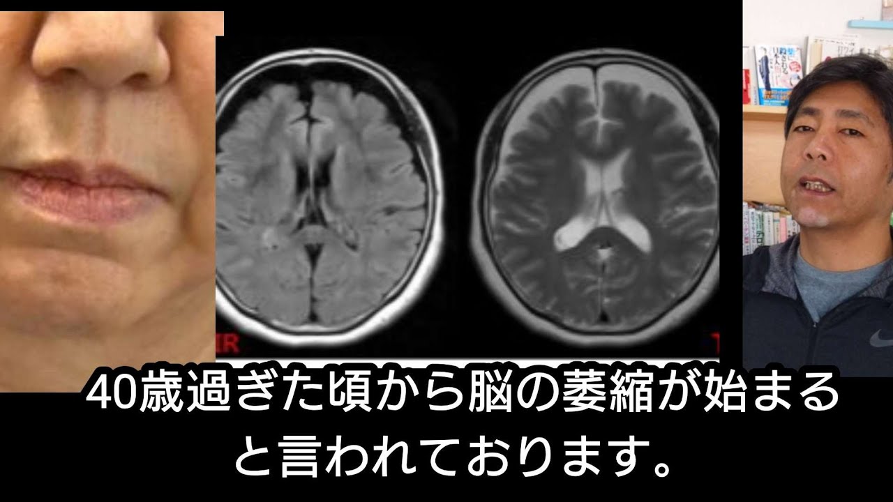 40歳から脳の萎縮が始まるそうです。あなたは、どう脳を守りますか？