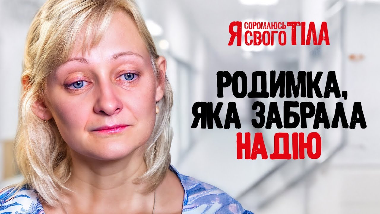 Невус, который разделил жизнь на ДО и ПОСЛЕ – Я соромлюсь свого тіла | МЕДИЦИНА | ВРАЧИ | ЗДОРОВЬЕ