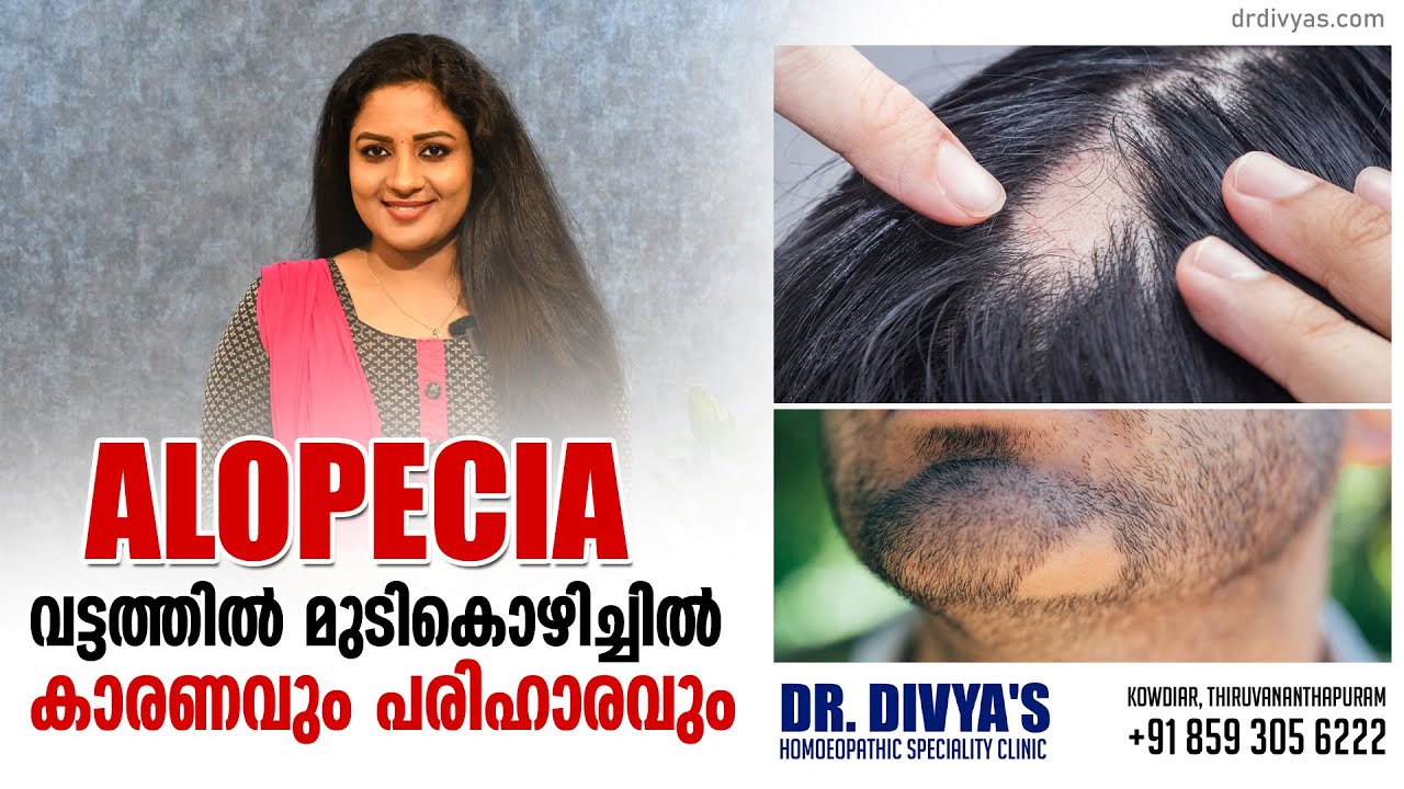 വട്ടത്തിൽ മുടികൊഴിച്ചിൽ കാരണവും പരിഹാരവും | ALOPECIA AREATA - Causes and Treatment of Hair Loss