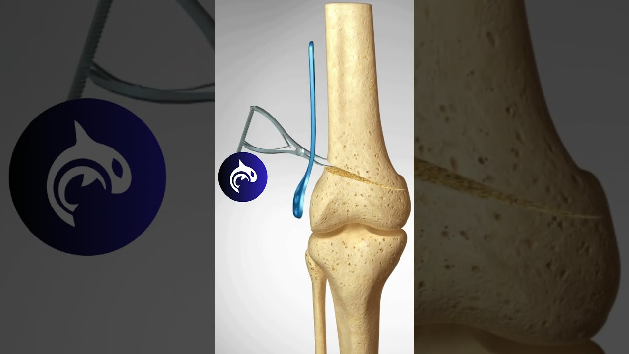 Distal Femoral Osteotomy of the Knee - 3D animation #knee #kneepain #orthopedics