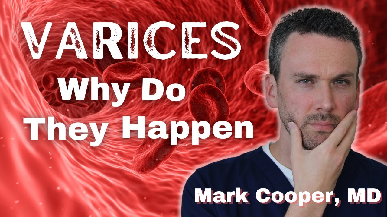 Varices - What Are They And Why They Occur?