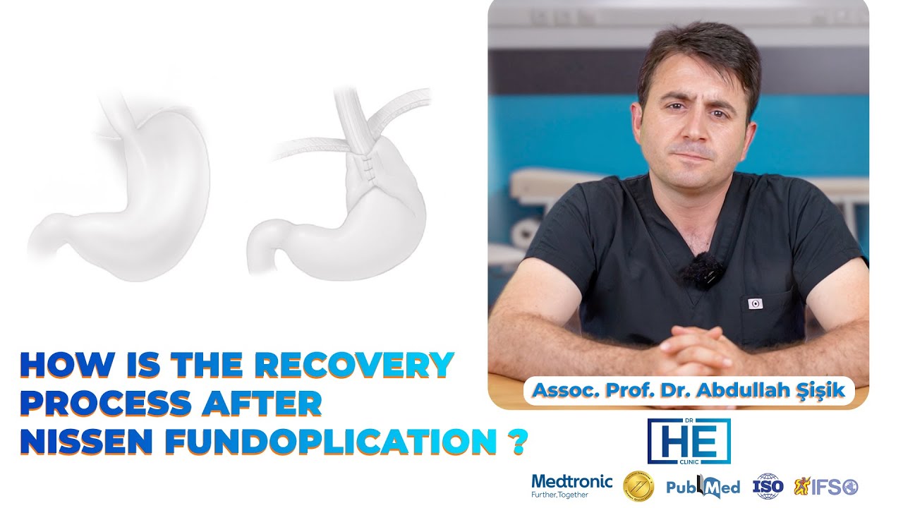 How Is The Recovery Process After Nissen Fundoplication ?