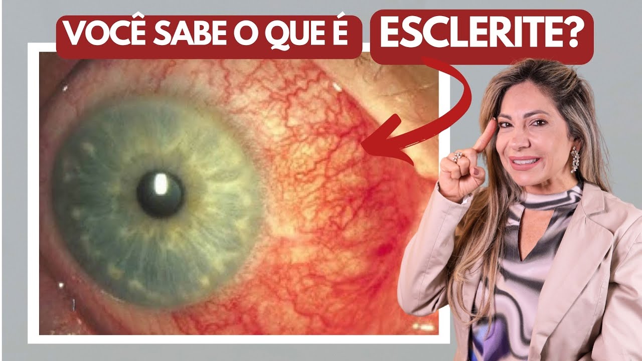 Esclerite: Tudo Que Você Precisa Saber Sobre!