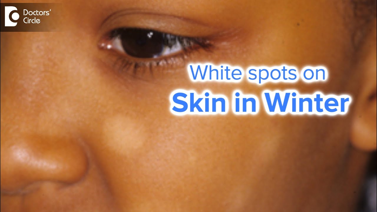White spots on face in winter | CAUSES , PREVENTION & TREATMENT - Dr. Nischal K | Doctors' Circle