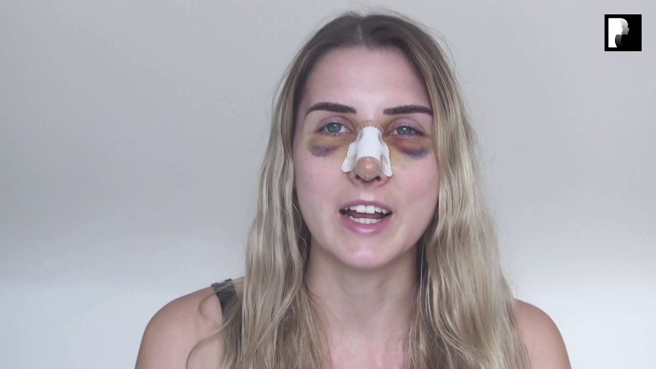 Rhinoplasty Video Diary - Day 4 After Surgery (4 of 15)