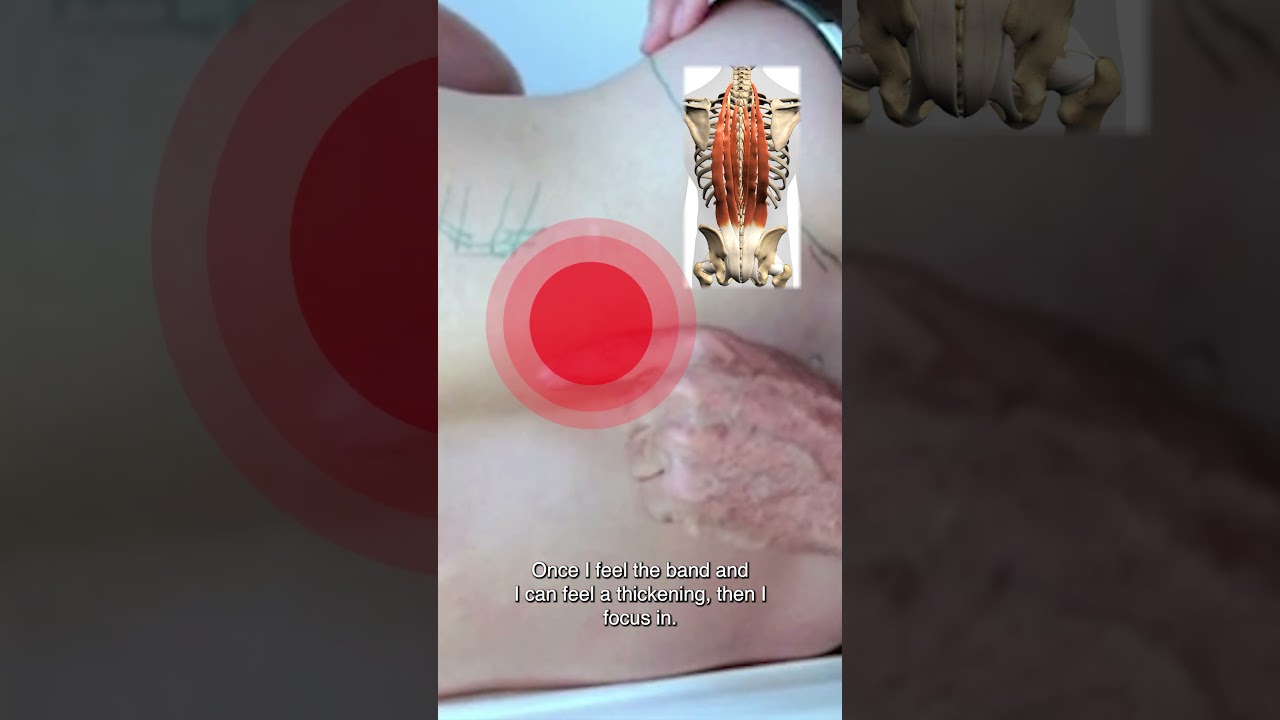 Treating erector spinae trigger points