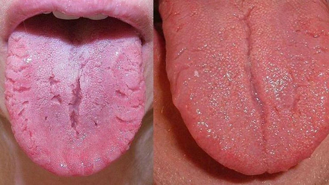 TONGUES WITH LONG VERTICAL MIDLINE CRACK QUIZ