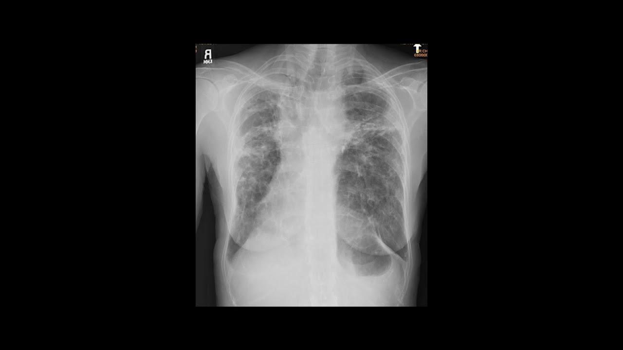 V/Q Case Review | 15 Minute Radiology CME