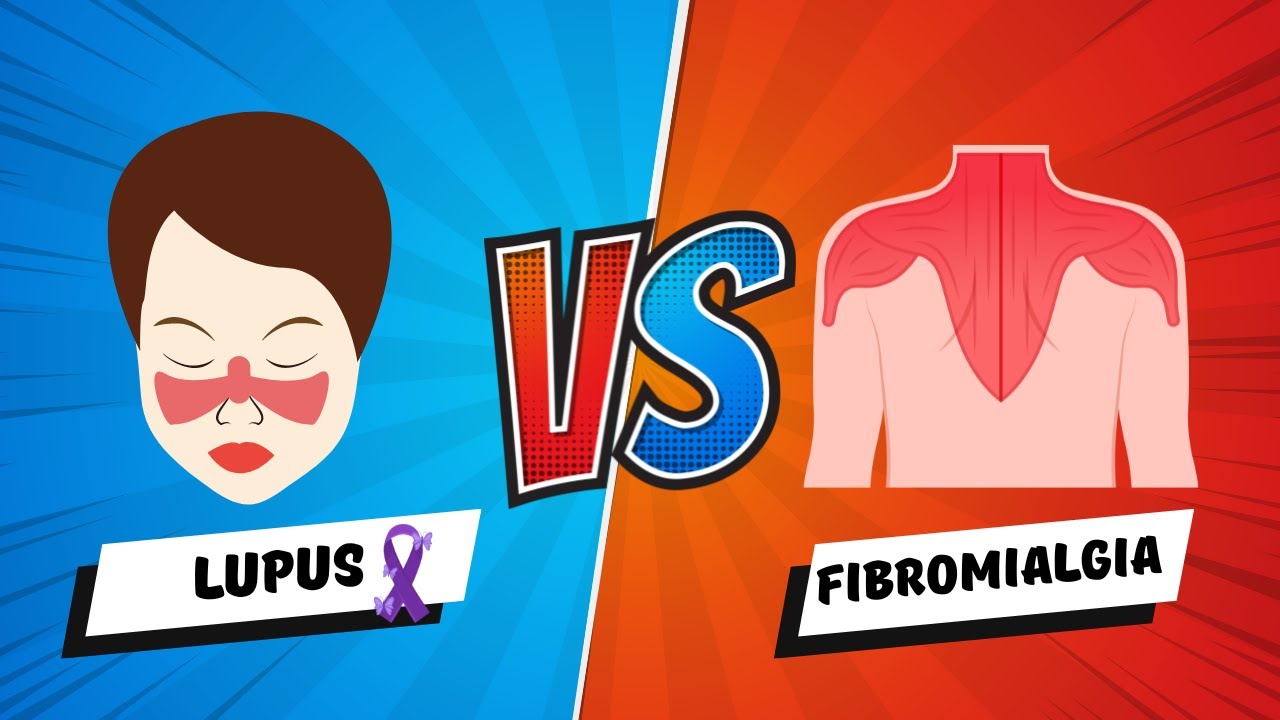 Lupus vs Fibromialgia: grandes similitudes y dispares diferencias.