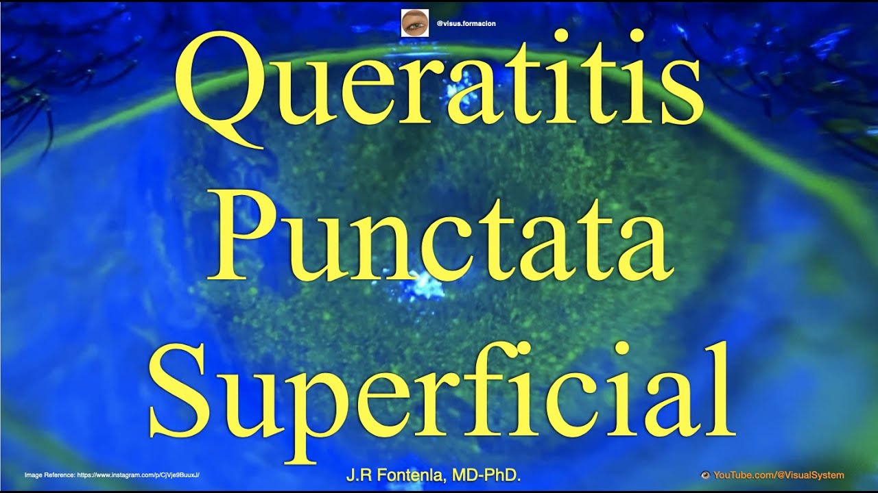 Queratitis Punctata Superficial.