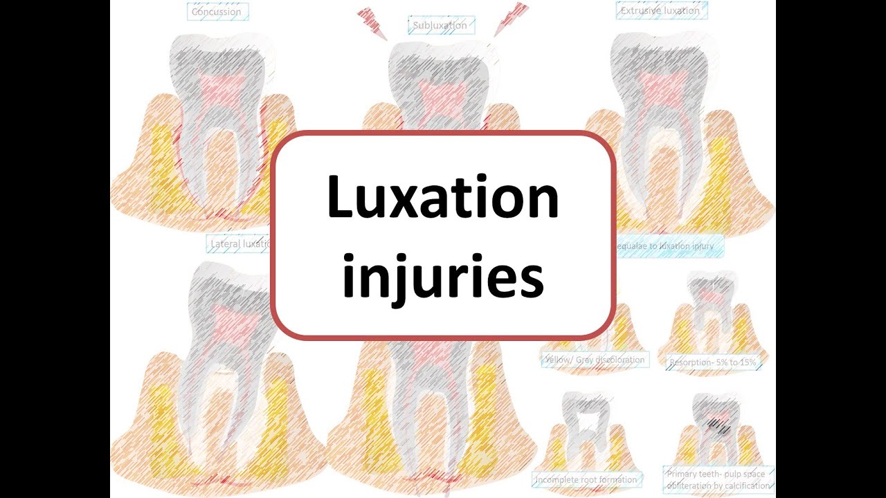 Luxation Injuries: Concussion, Subluxation, Extrusive, Lateral & intrusive luxation