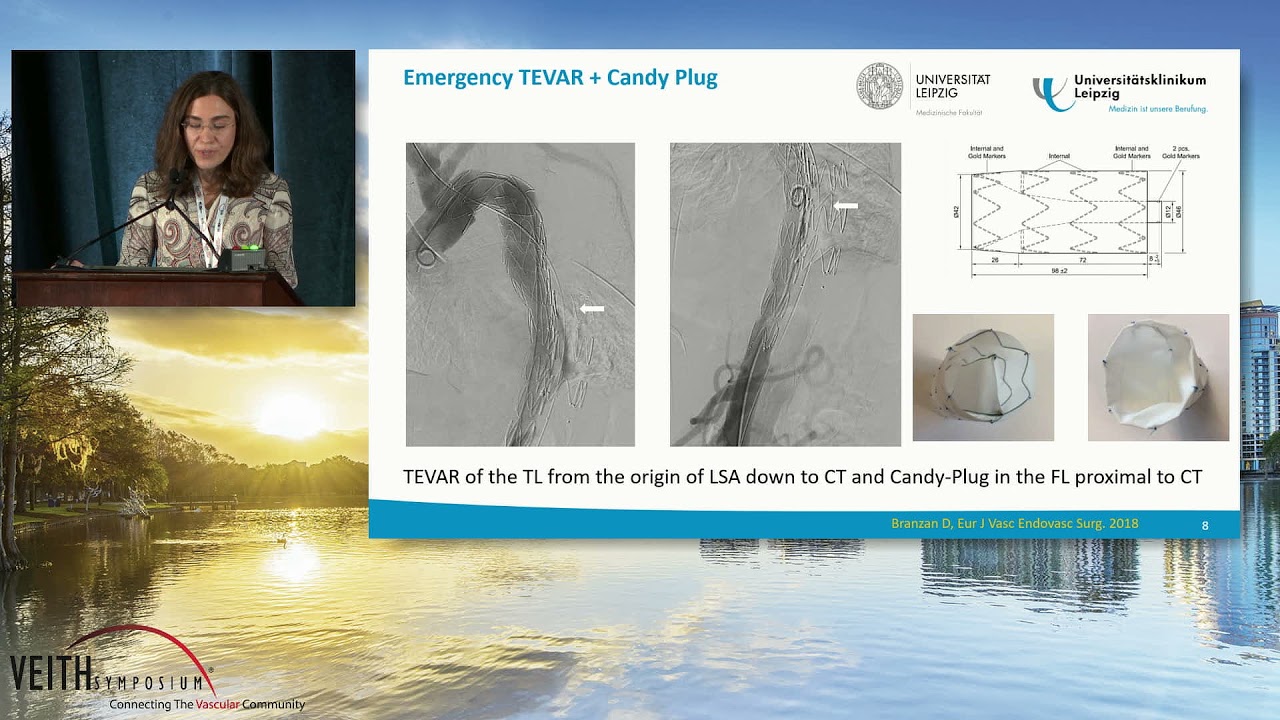Emergency Treatment As Aortic Rupture From Chronic TBAD Using The Candy Plug Technique