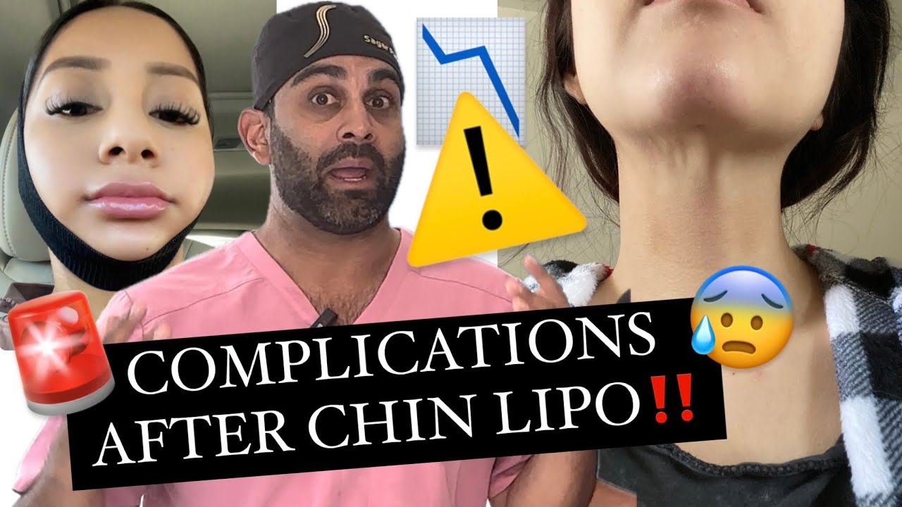 Complications After Chin Lipo *what to look out for*
