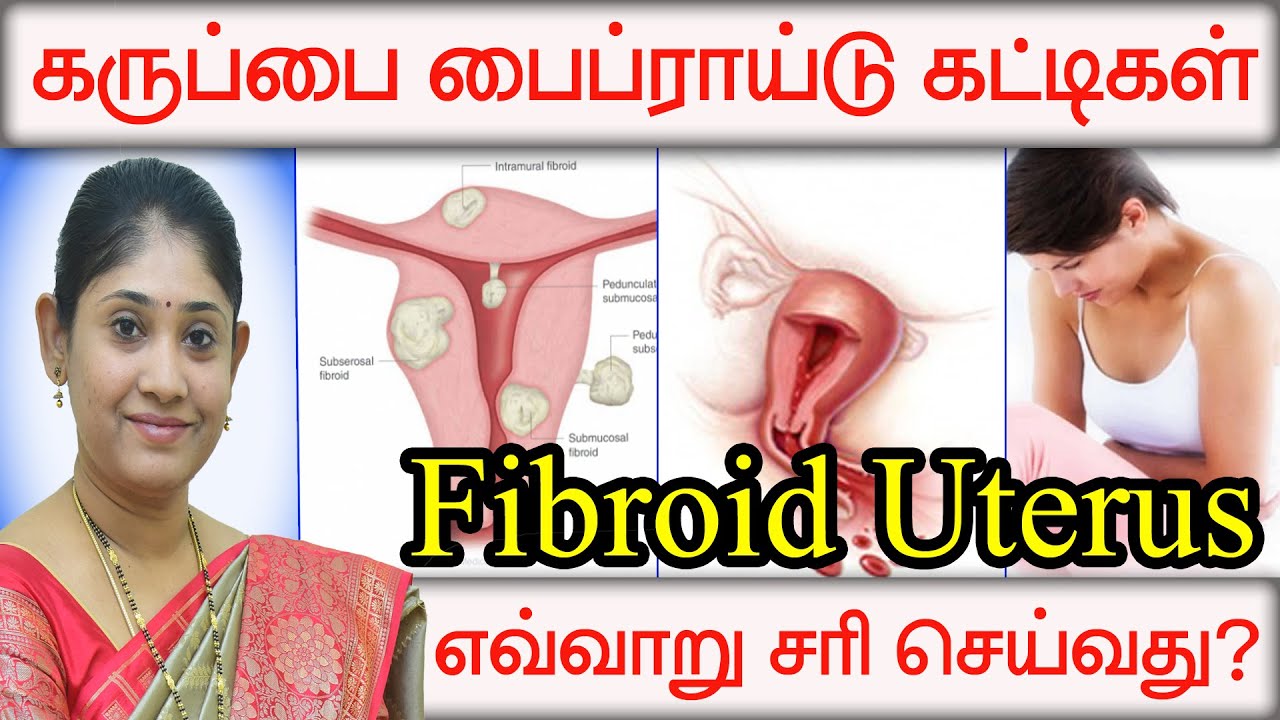 கருப்பை பைப்ராய்டு கட்டிகள் என்றால் என்ன வகைகள் எவ்வாறு சரி செய்வது  What is Uterine Fibroids