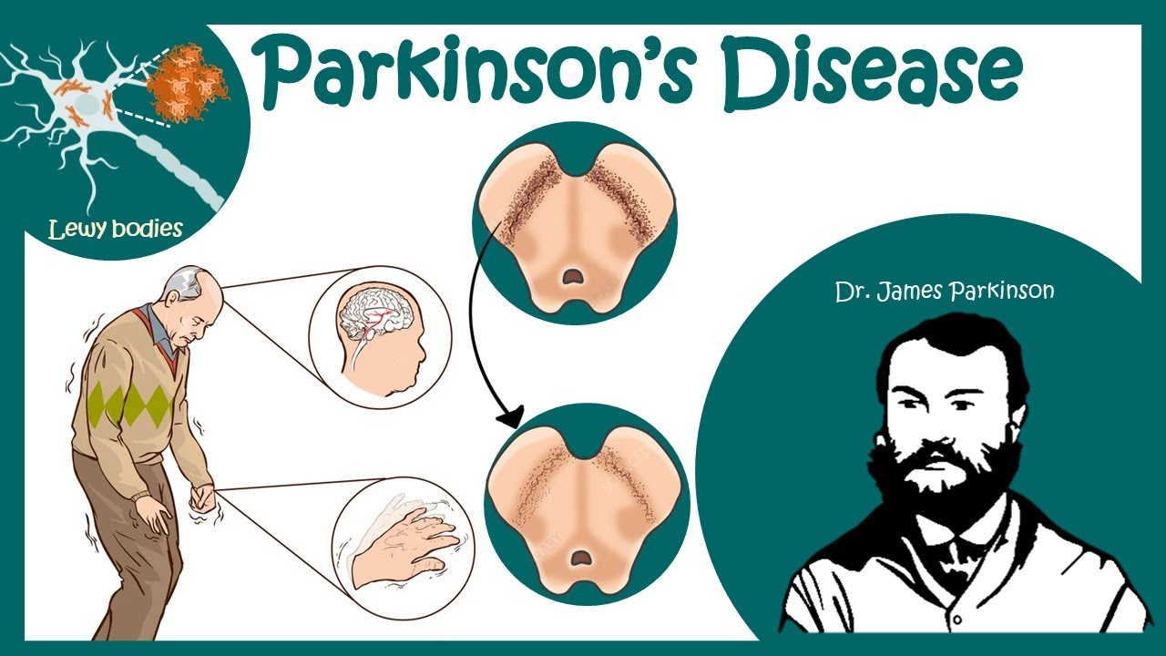 Parkinson's Disease (Shaking Palsy) | Clinical Presentation & Pathophysiology of Parkinson's disease