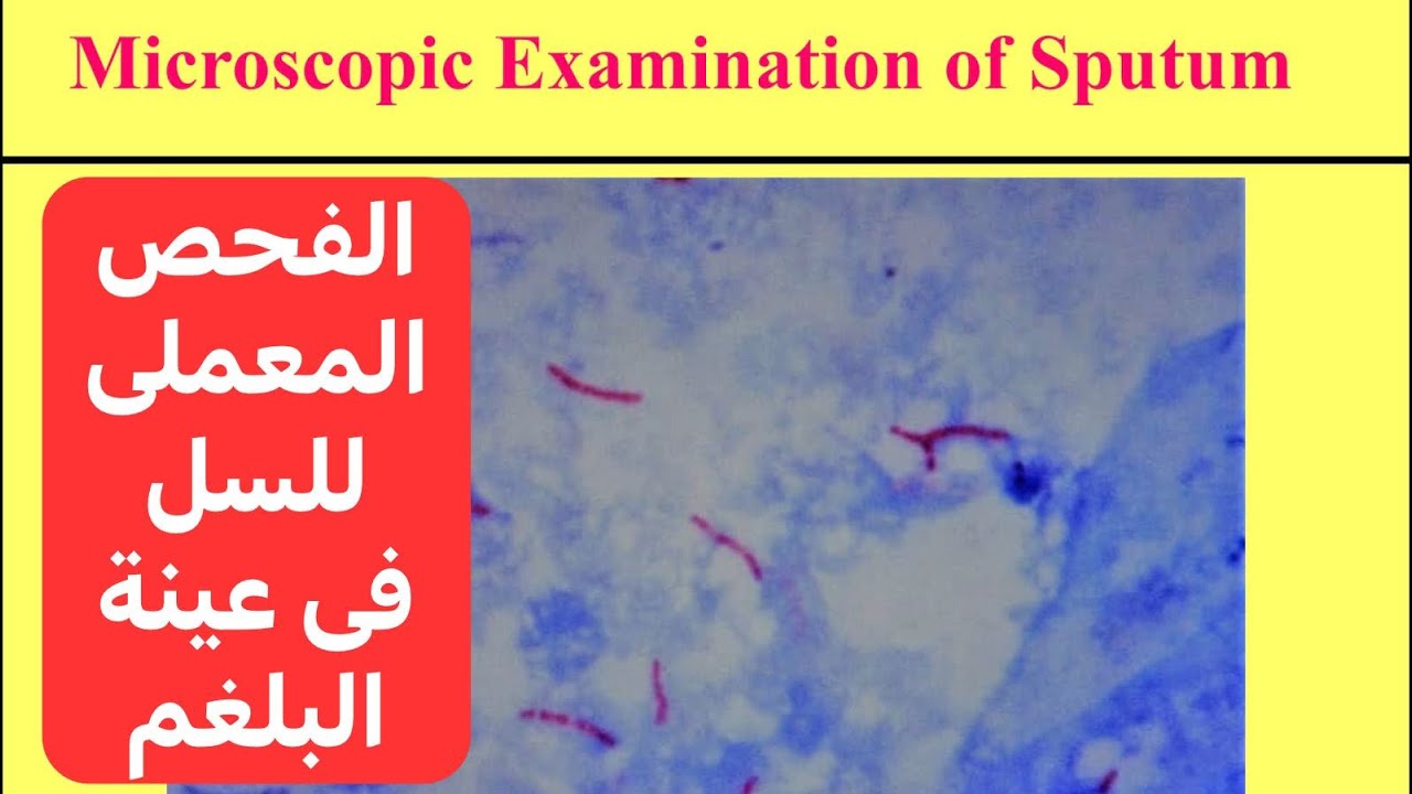 التشخيص المعملى لميكروب السل (فحص عينة البلغم) Sputum Examination for Diagnosis of T.B.