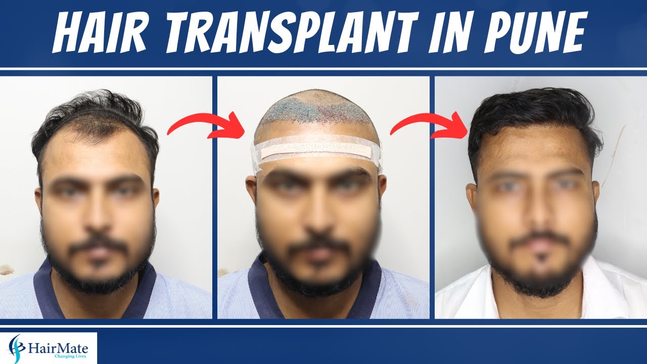 Hair Transplant in Pune - Natural FUE Results || Natural Results & Affordable Cost
