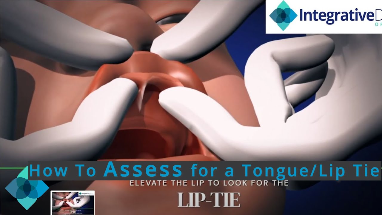 How To Assess for a Tongue/Lip Tie