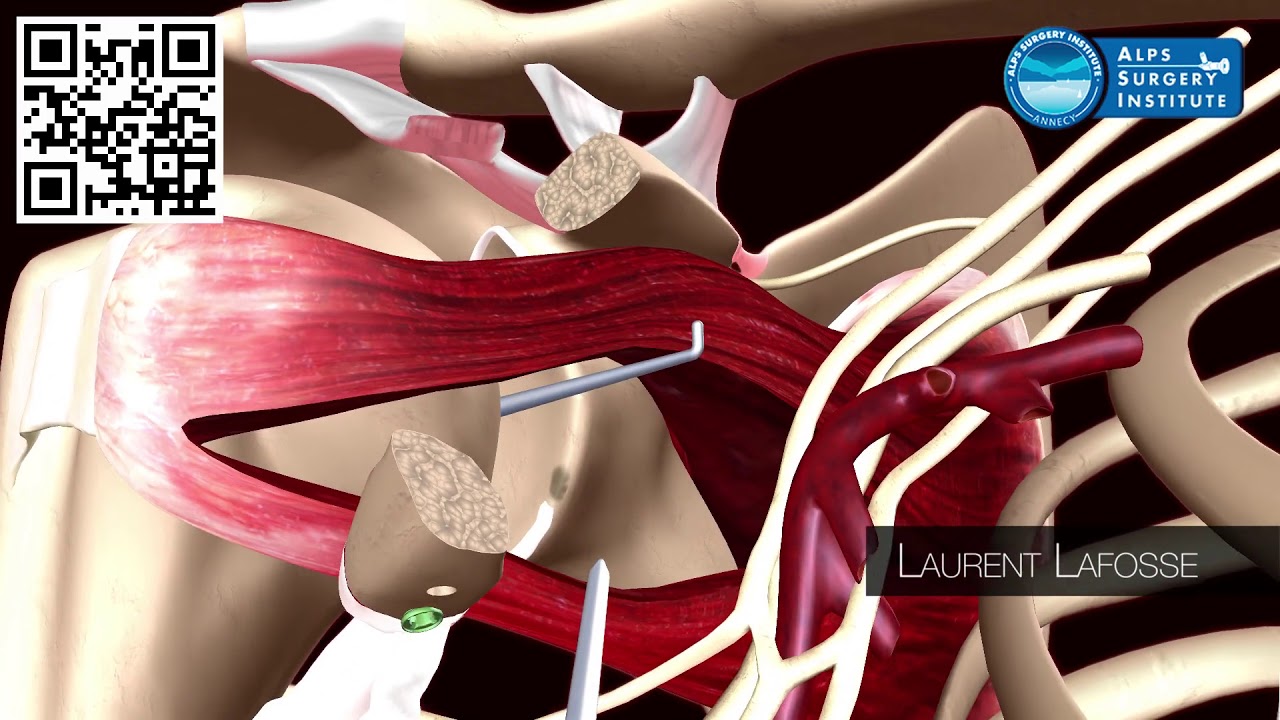 Arthroscopic Latarjet by Laurent Lafosse
