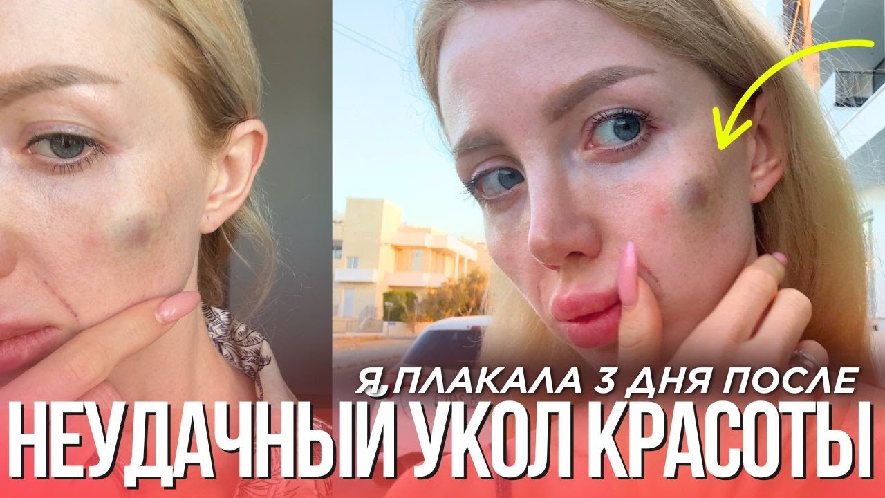 МОЙ ПОХОД К КОСМЕТОЛОГУ ОБЕРНУЛСЯ ДРАМОЙ. НОСОГУБКА, СКУЛЫ И РАДИЕСС. МОЙ ГОРЬКИЙ ОПЫТ