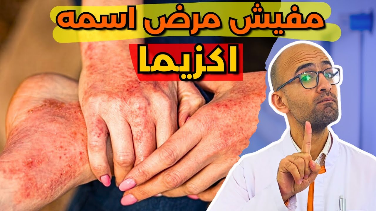يعني ايه اكزيما ؟ اسباب الاكزيما و انواعها و علاجها