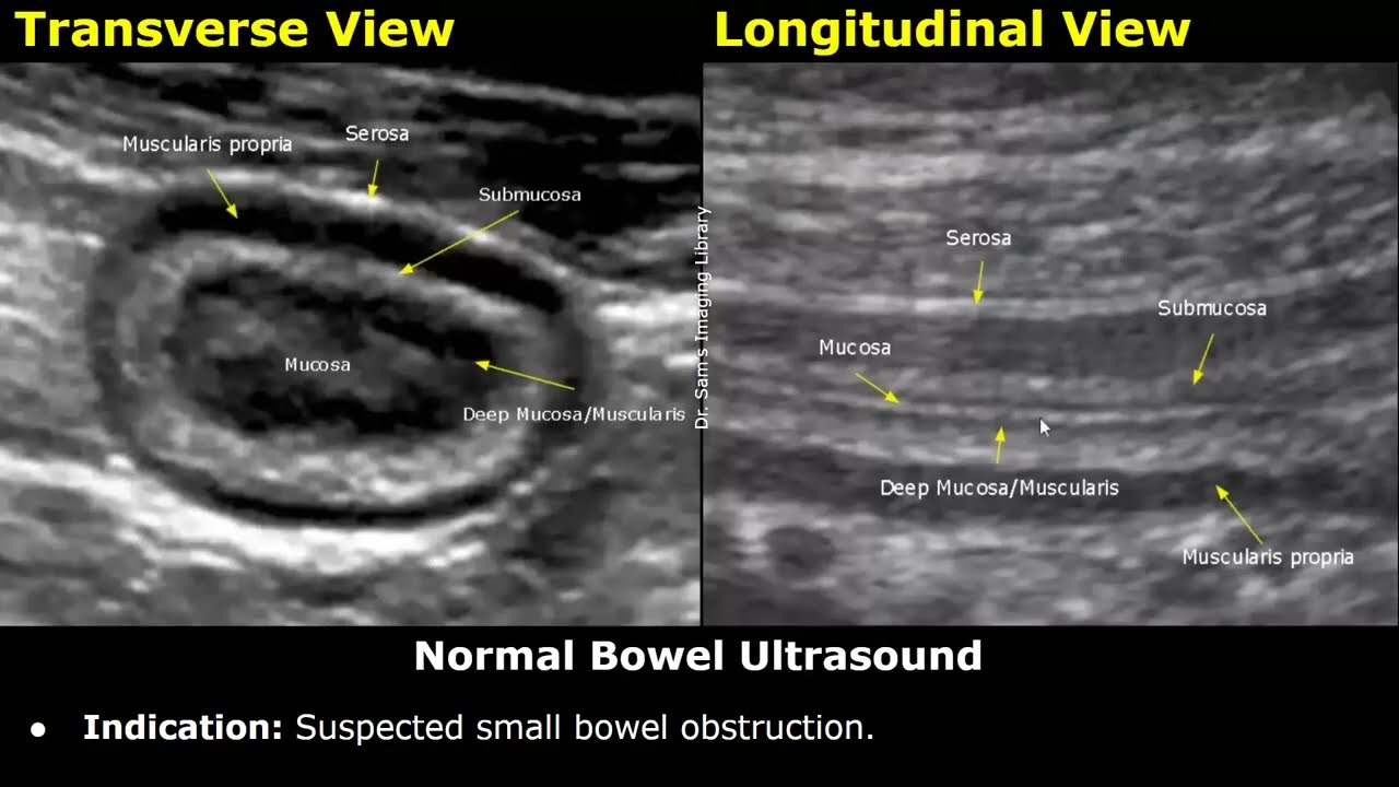 Small Bowel Ultrasound Reporting | How To Write USG Report | Bowel Obstruction, Crohn's Disease