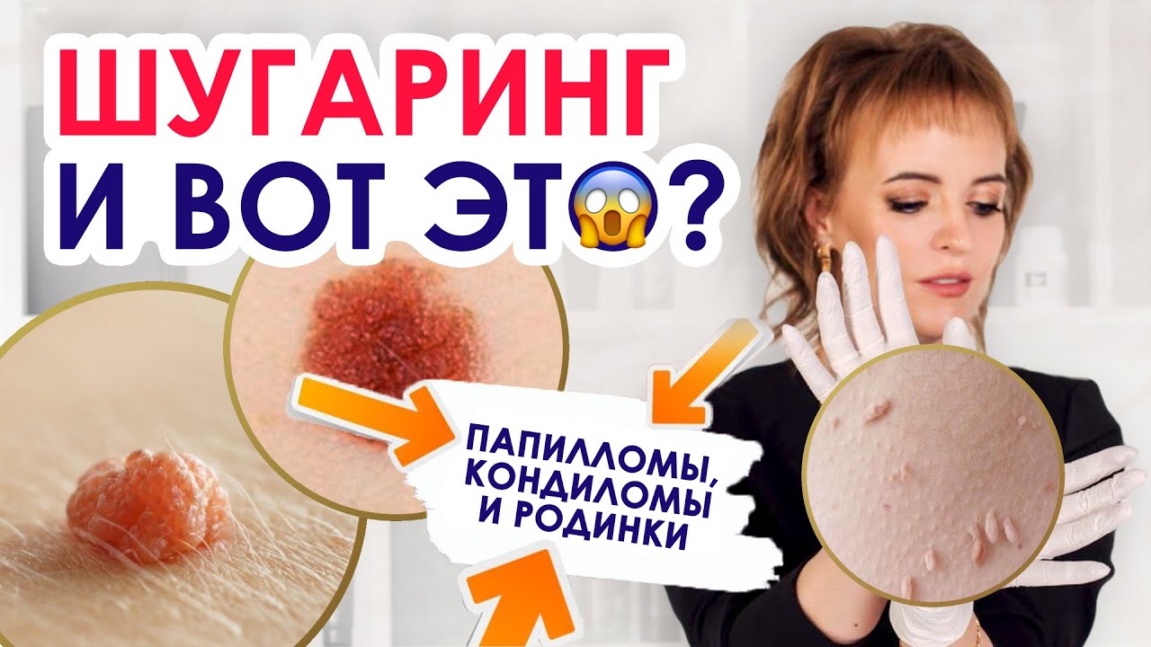 ШУГАРИНГ И ПАПИЛЛОМЫ |  Особенности кожи | Папилломы, кондиломы и родинки – противопоказания?