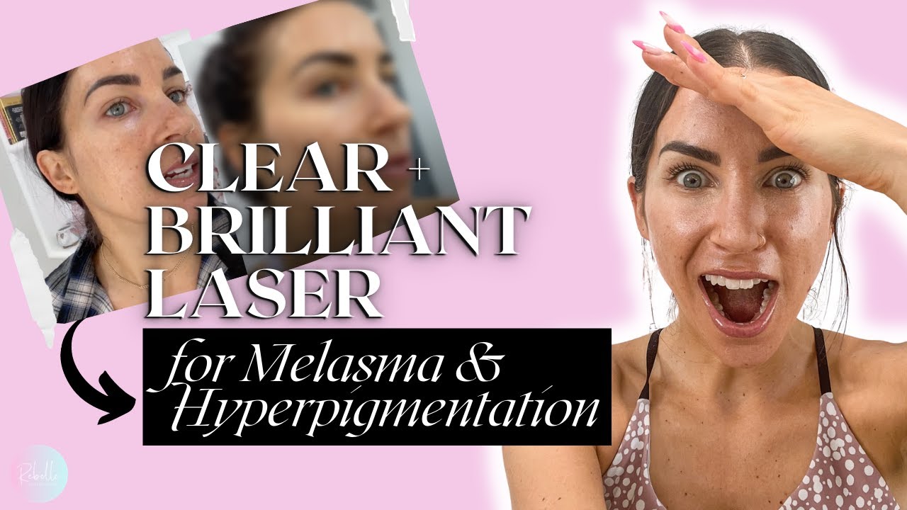 I Tried the Clear + Brilliant Laser for Hyperpigmentation and Melasma // REBELLE NUTRITION