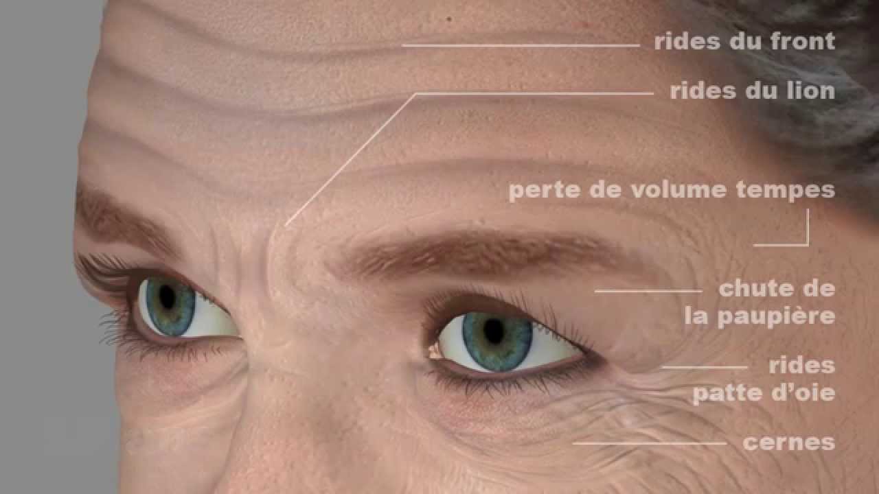 Injections d'acide hyaluronique (volume, souplesse, hydratation de la peau) par le Dr Navarro à Aix