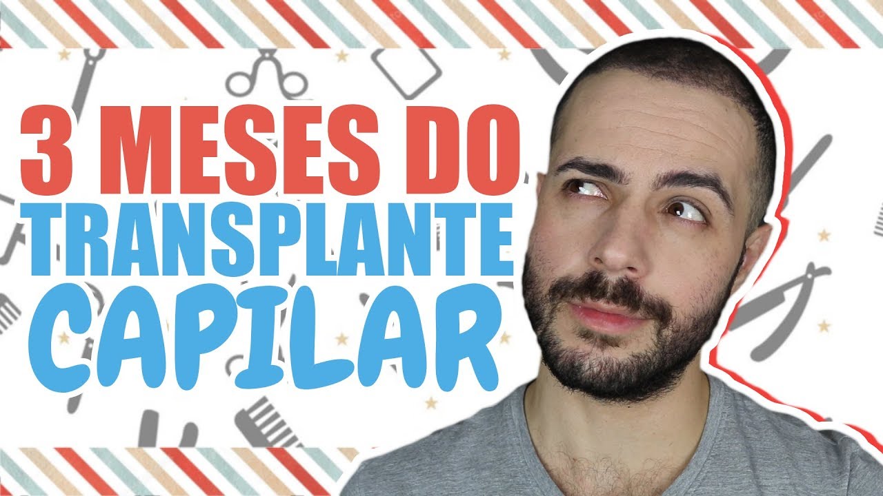 3 MESES DO MEU TRANSPLANTE CAPILAR NA TURQUIA