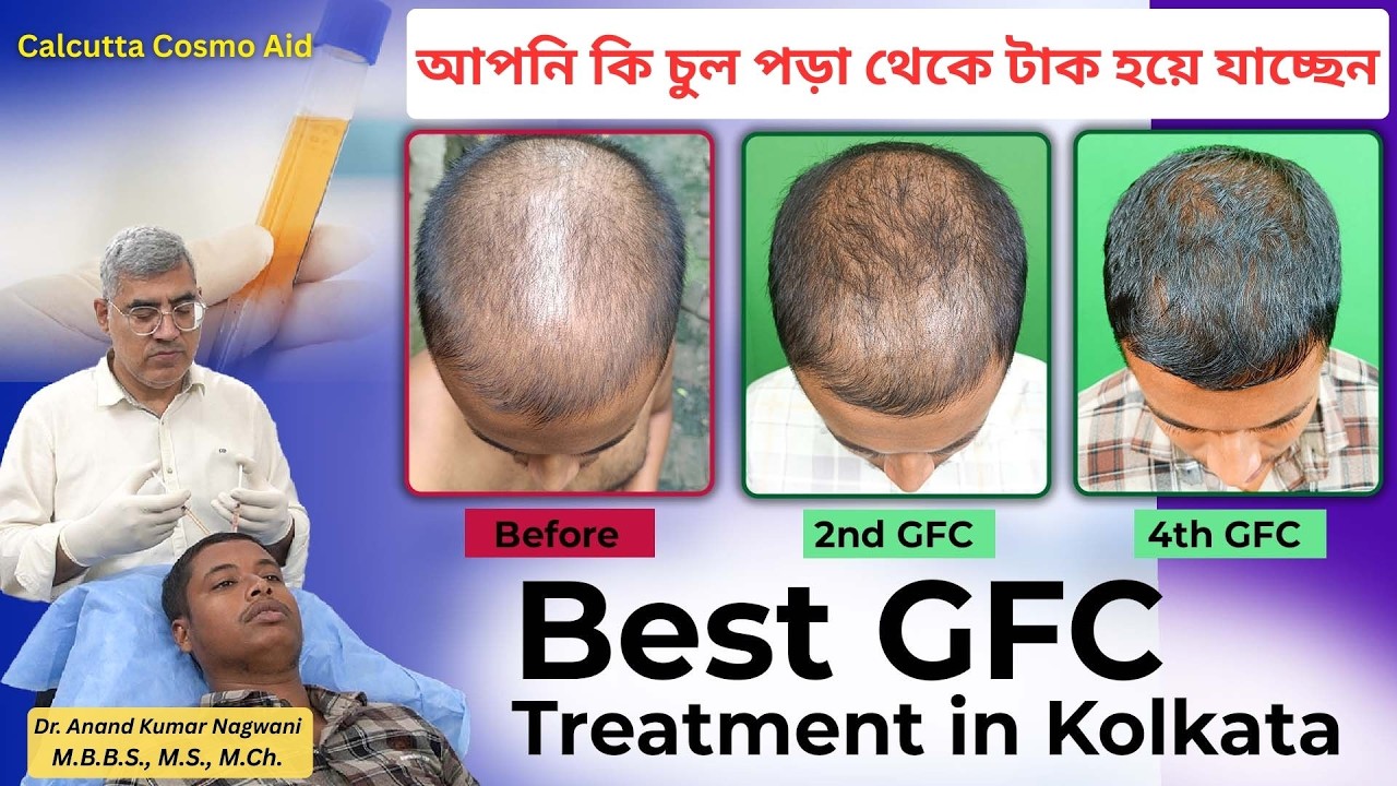 আপনি কি চুল পড়া থেকে টাক হয়ে যাচ্ছেন | Best GFC treatment in Kolkata | CalcuttaCosmoAid |DrNagwani