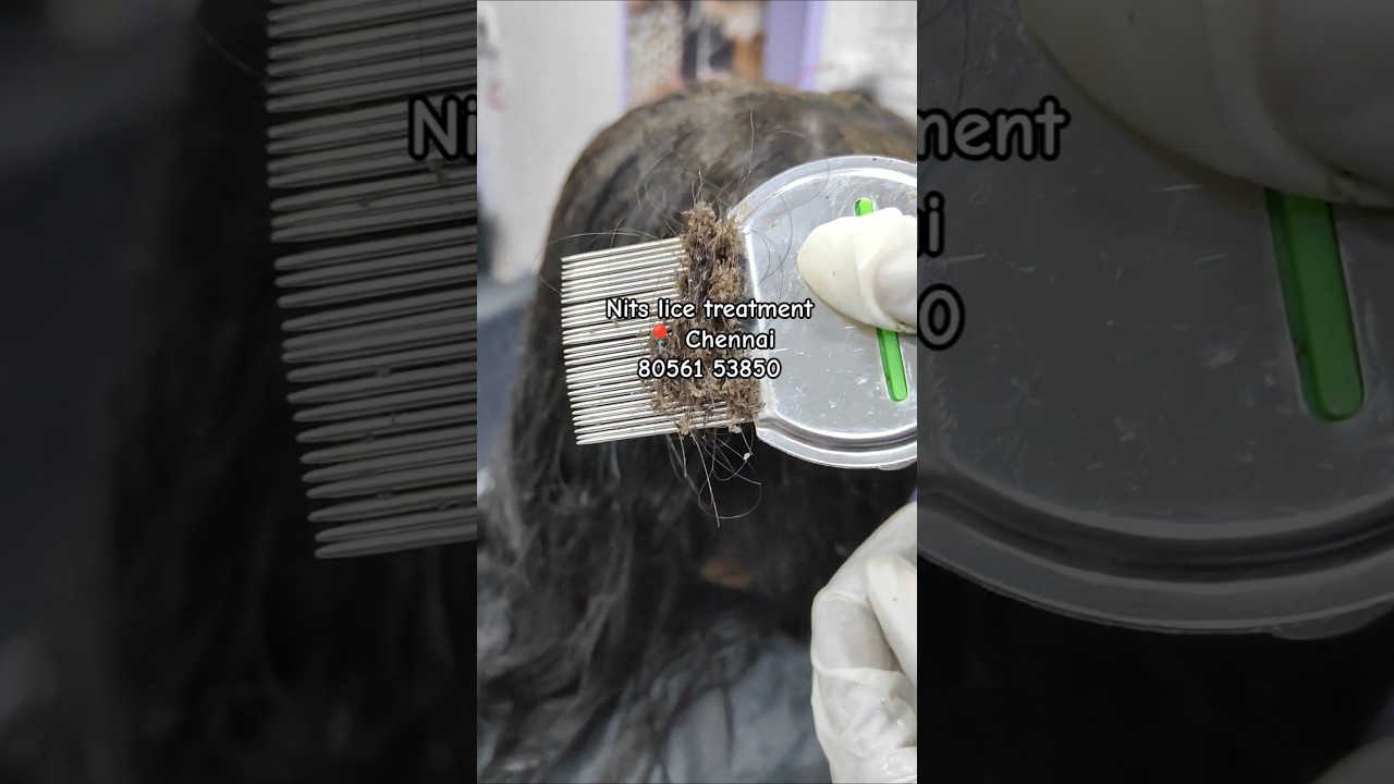 Nits lice treatment in Chennai within 2 hrs #headlice#headliceremoval#haircare#licetreatment#lice#