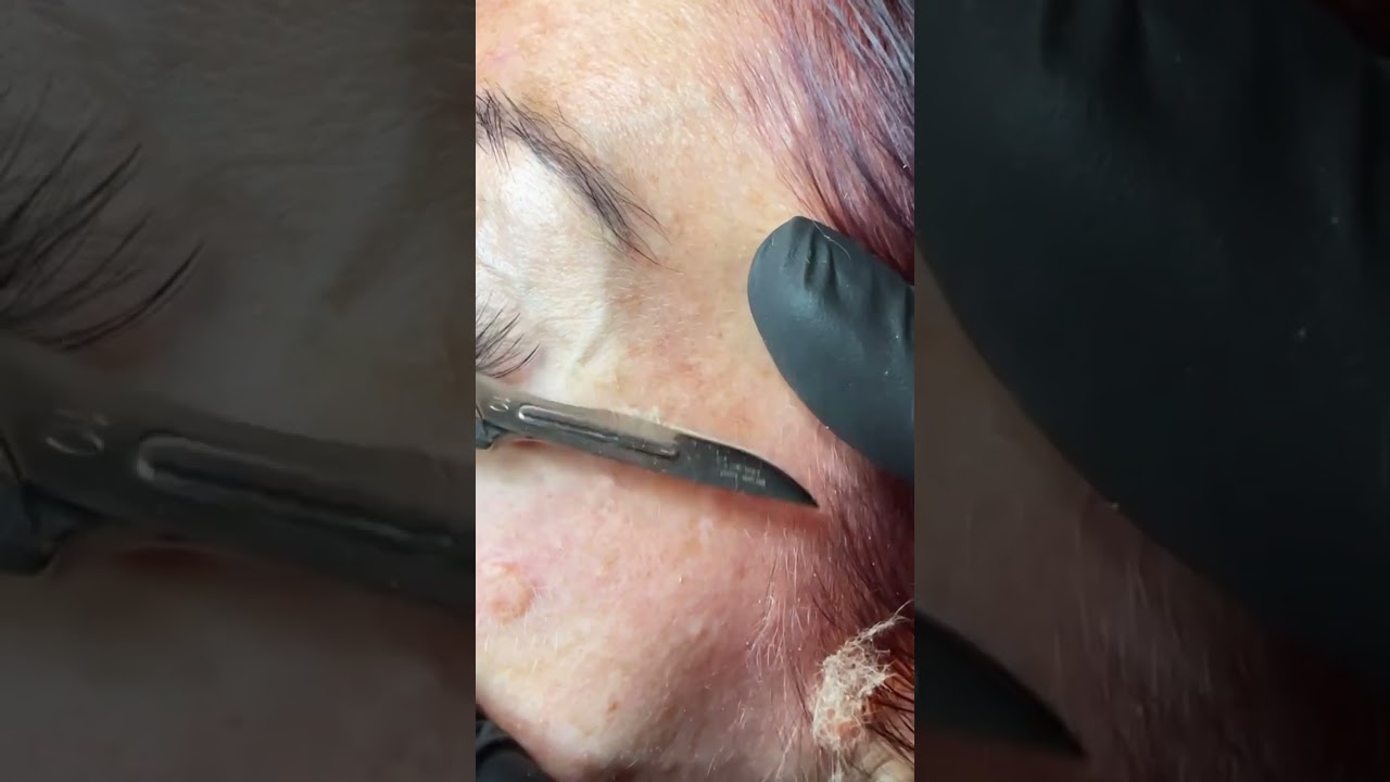 Dermaplaning with Mask @medandspaburrridge  #dermaplaning #facial #skincareroutine