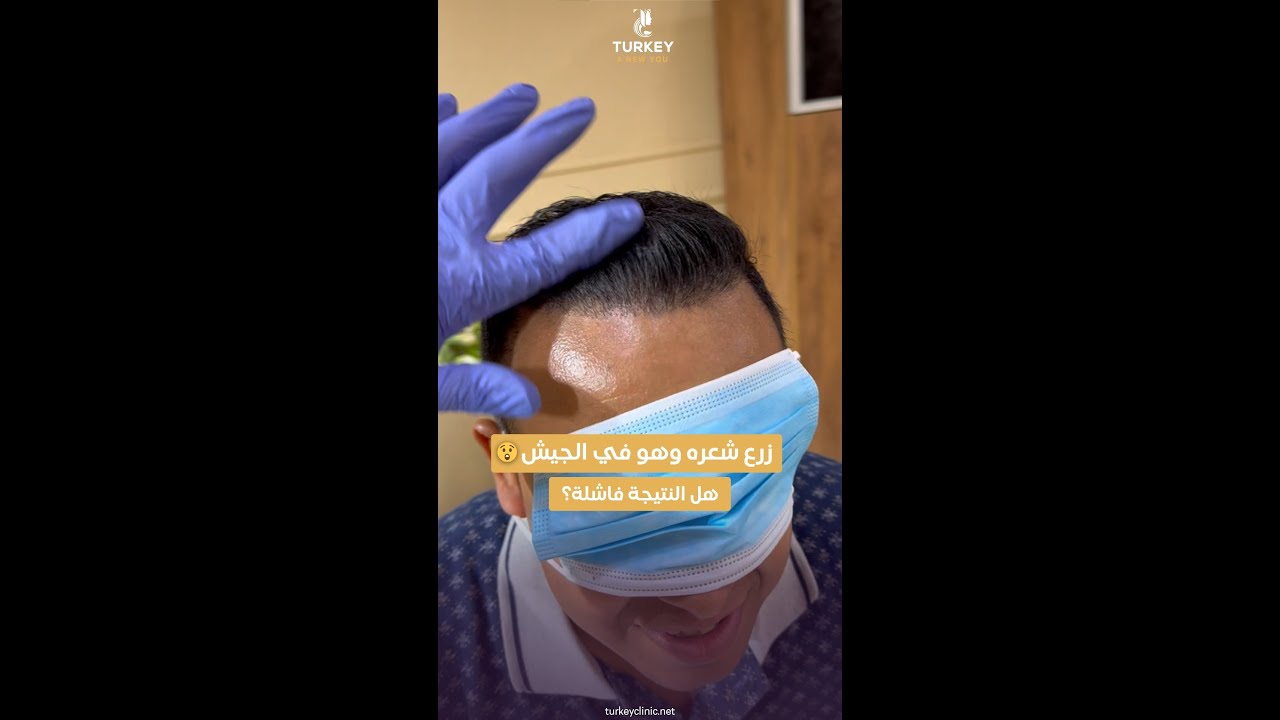 نتيجة زراعة الشعر بعد 6 شهور | زرع وهو داخل الجيش والنتيجة مفاجأة - تركي هير كلينك د. أحمد البرعي