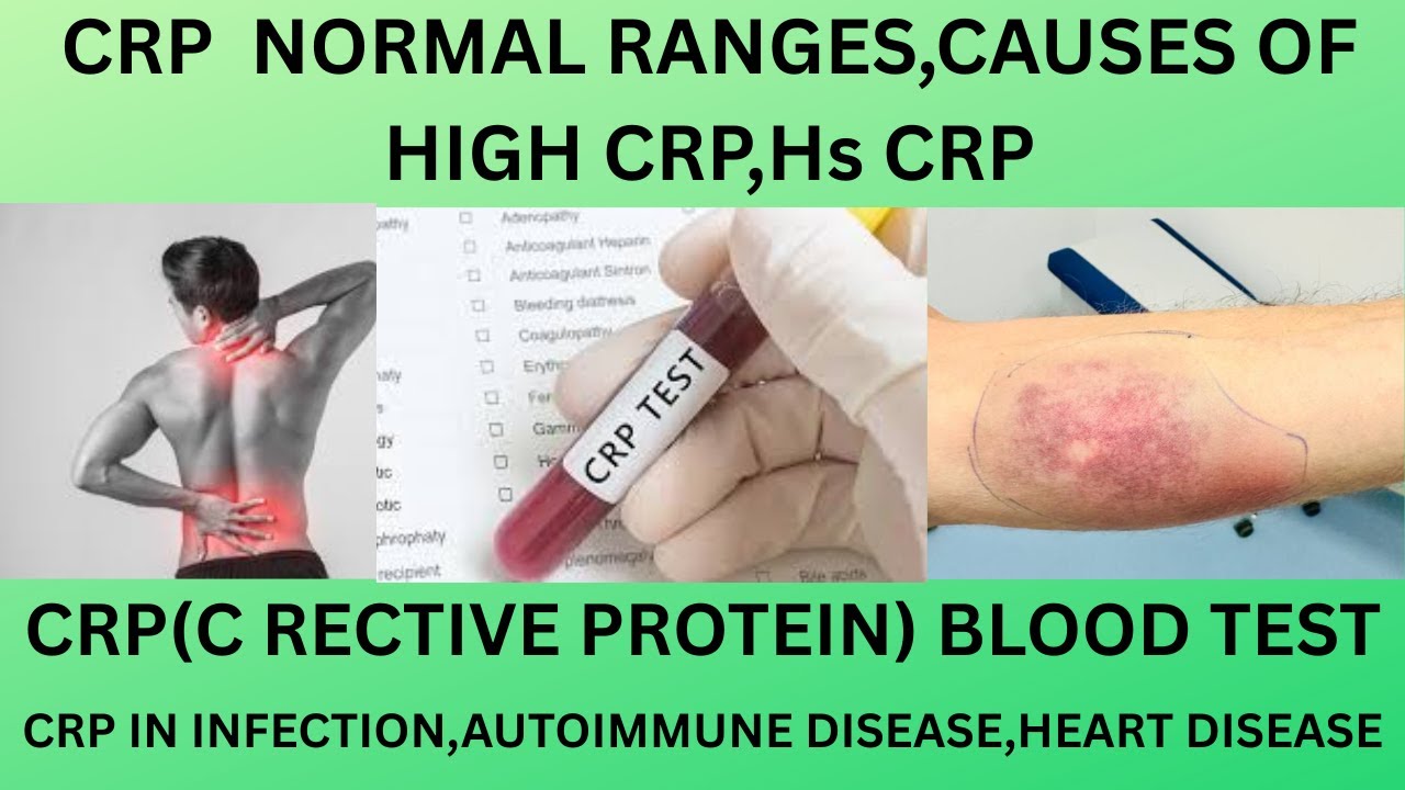 CRP(C REACTIVE PROTEIN).CRP BLOOD TEST.NORMAL RANGE,CAUSES OF HIGH CRP,Hs CRP ,HOW TO REDUCE CRP?