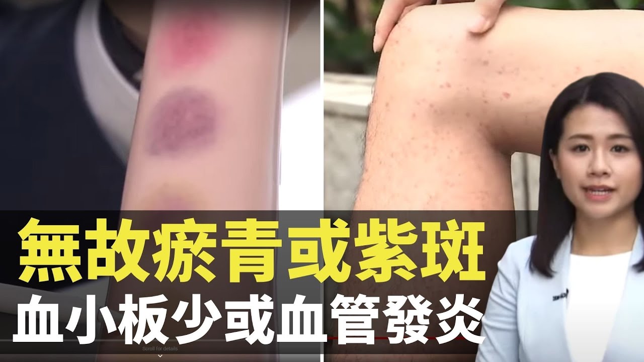 無故瘀青或紫斑  血小板少或血管發炎－  最強生命線 - 香港新聞 - TVB News- 黃靖婷