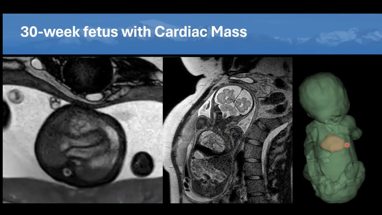 Webinar - Autumn Session 2025 - Shaping the future of fetal cardiac MRI