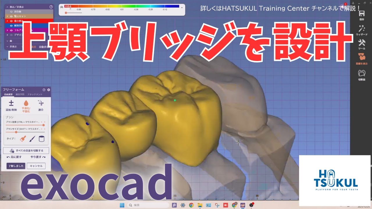 #302　exocad設計　上顎ブリッジを設計（解説なし版）