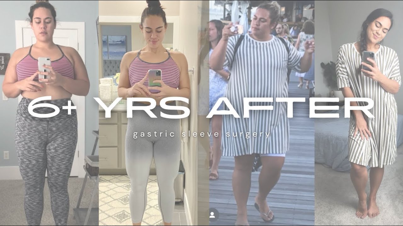 Gastric Sleeve Surgery-6 YRS LATER