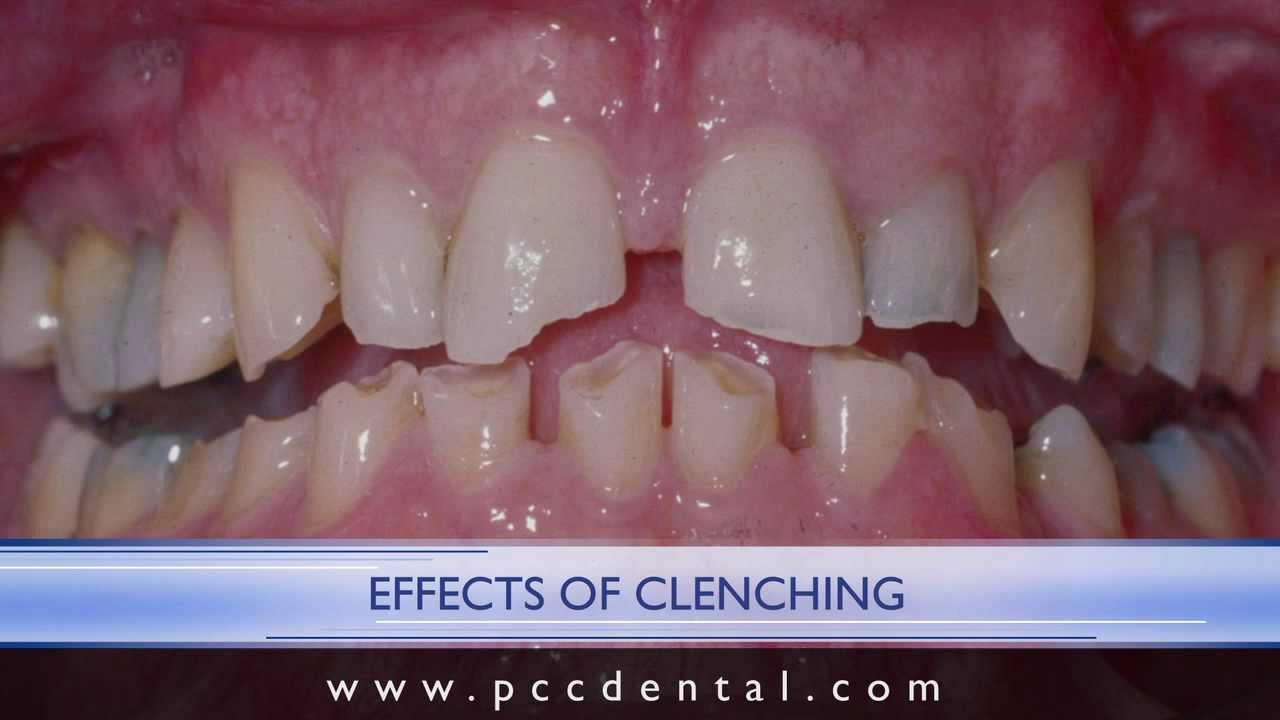 Ask Gordon: What is the difference between bruxism and clenching?