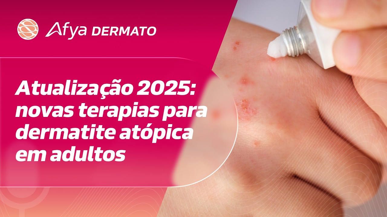 Atualização 2025: novas terapias para dermatite atópica em adultos