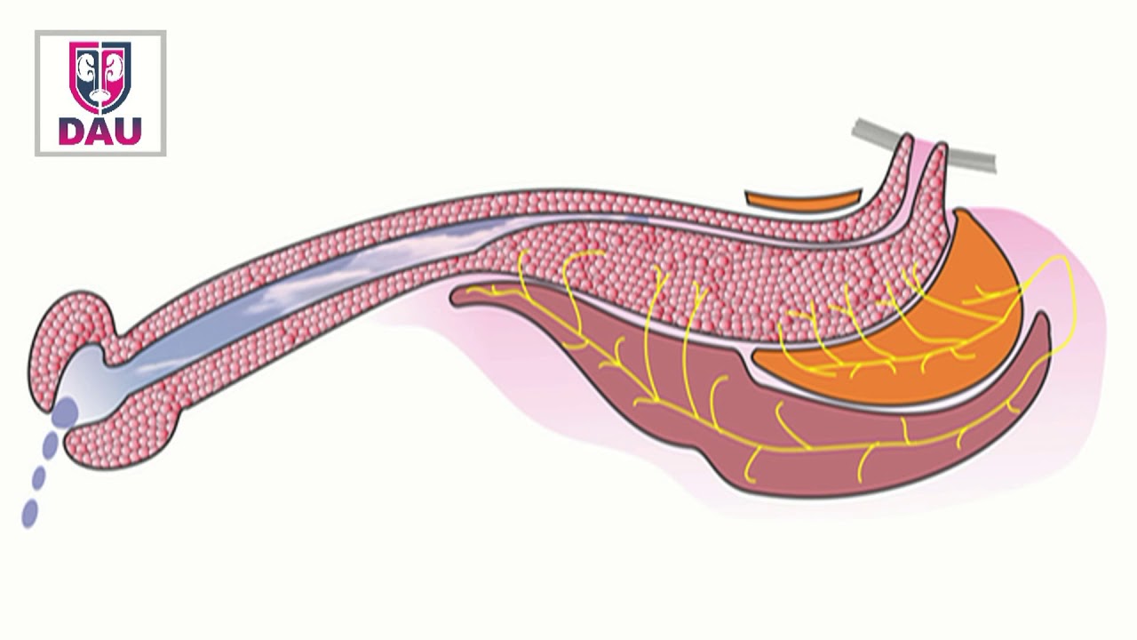 Why should the bulbospongiosus be spared during urethroplasty