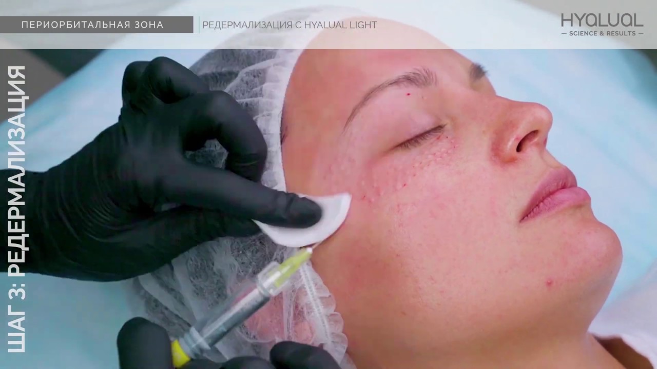 Видео-инструкция по процедуре Редермализации периорбитальной зоны препаратом Hyalual Light